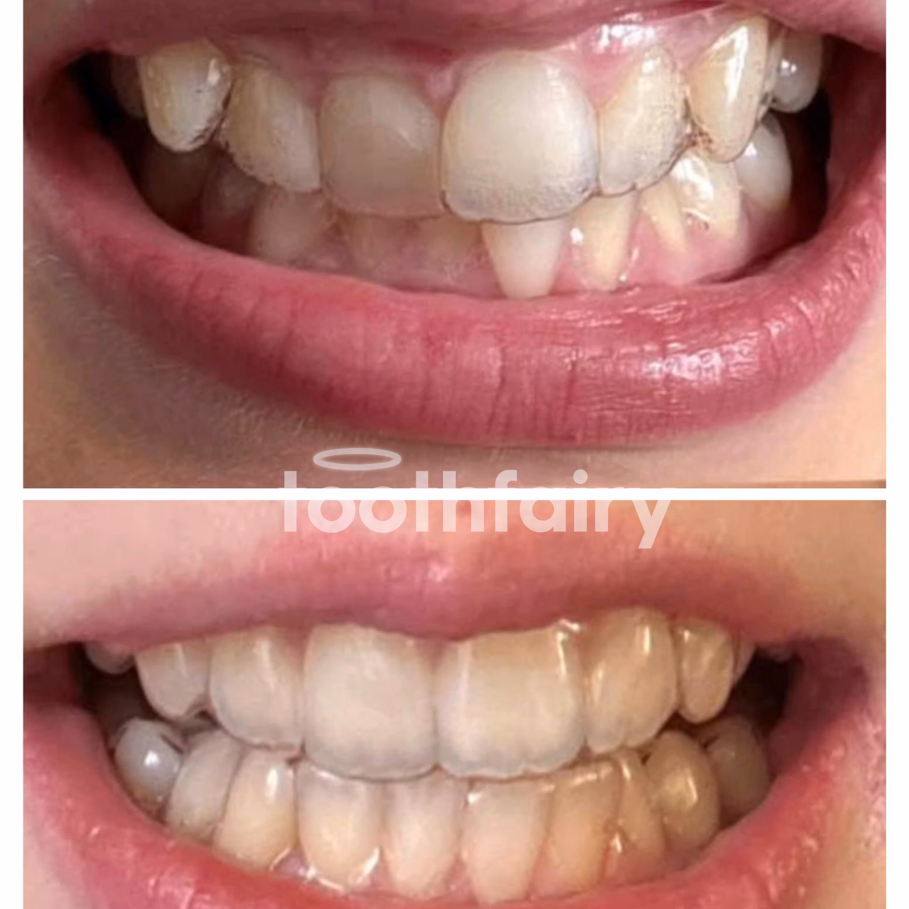 Toothfairy - Overlapped and crowded incisors