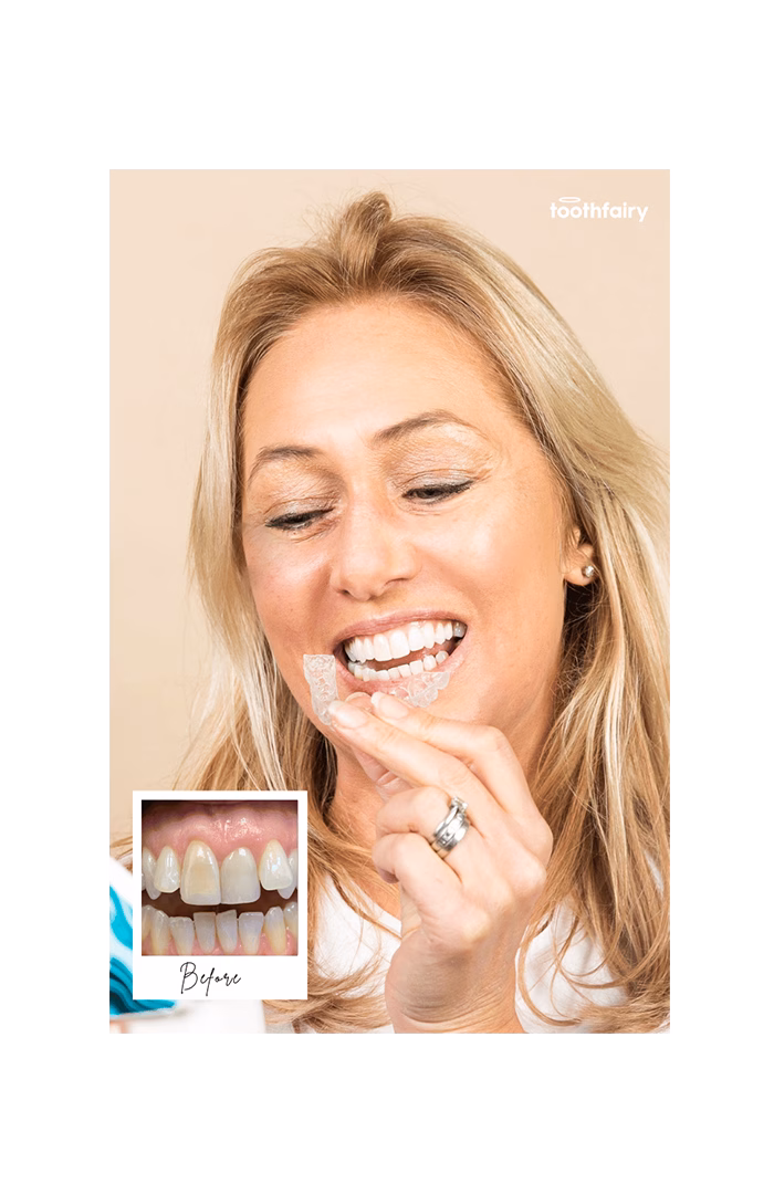 Toothfairy - Patient spotlight - Gap Closures